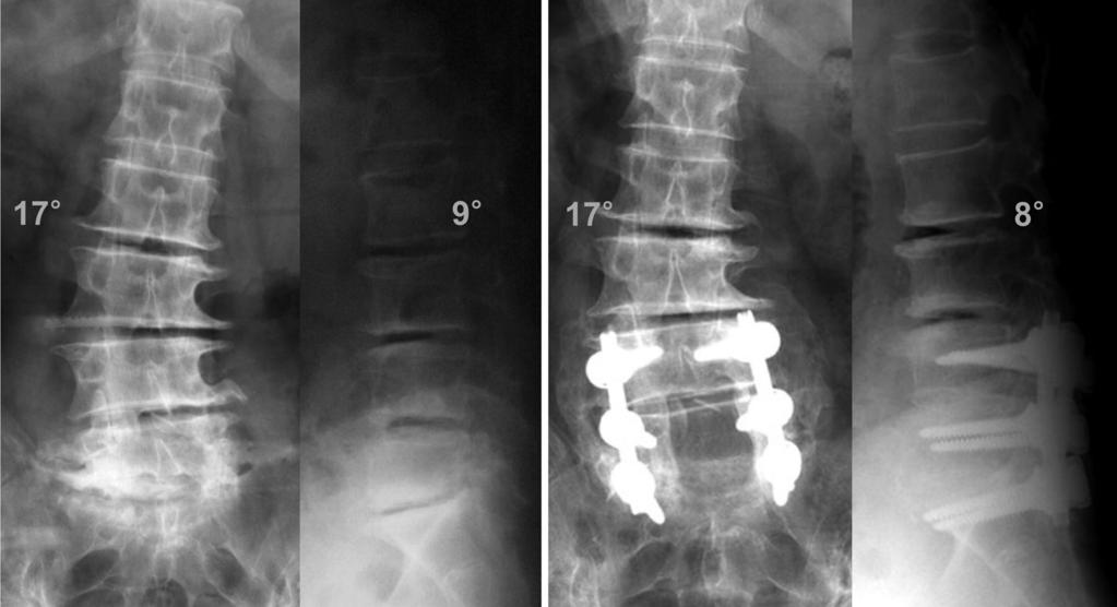 376 Kyu-Jung Cho et al. Asian Spine J 2014;8(3):371-381 The goal of surgery is to relieve back pain, improve radiating pain and claudication and correct deformity [19,20].