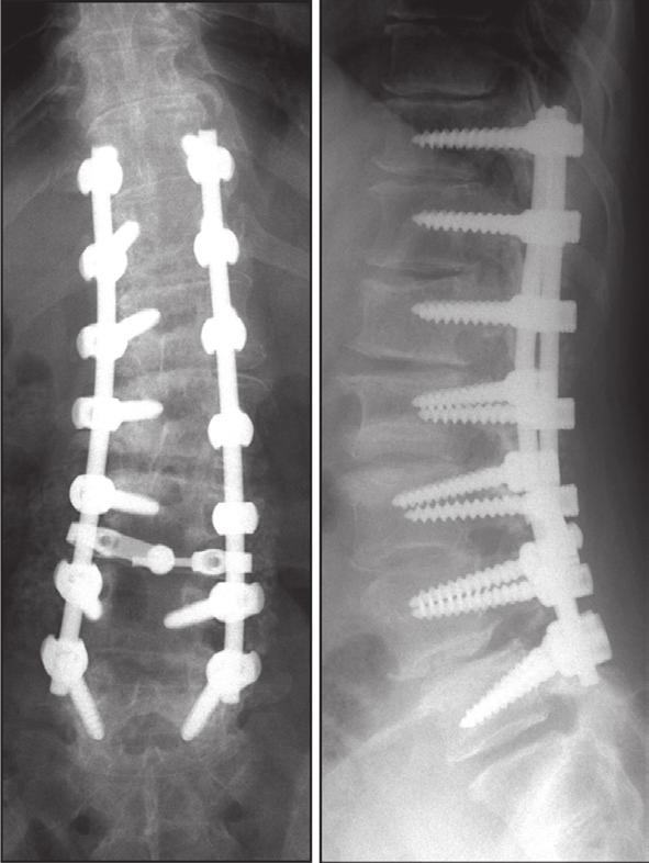 (A) This 72-yearold woman had adult degenerative scoliosis with 35 o Cobb angle scoliosis