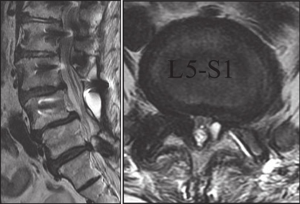 (B) Decompression and fusion at T11 L5 was performed as the L5 S1 disc was healthy on