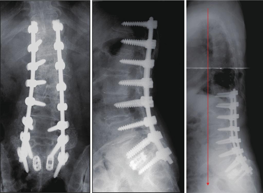 (D) A revision surgery (decompression and extension of fusion to the sacrum) was performed.