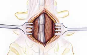 For a minimally invasive approach, this reflection of tissues extends to the base of the spinous process, which affords microsurgical access through the ligamentum flavum into the spinal canal.