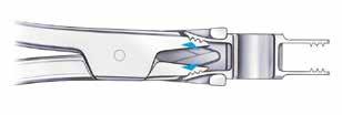 Once proper placement has been achieved, it is recommended to securely crimp the wings of the implant using the crimping plier.