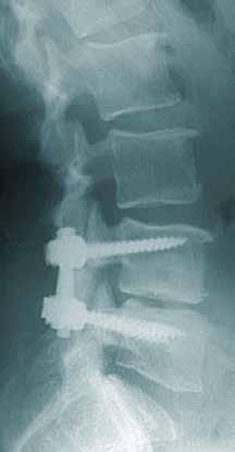 Preoperative 6 months 12 months 24 months 48 months Adjacent Segment The Rationale for challenging the gold standard In cases of spinal stenosis treatment requiring supplemental