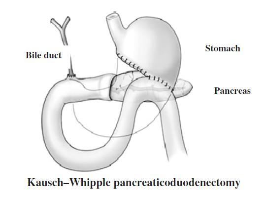 Pancreaticoduodenenctomy