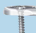 screws Anatomically shaped Recesses for screwheads in coaxial holes minimize screw prominence