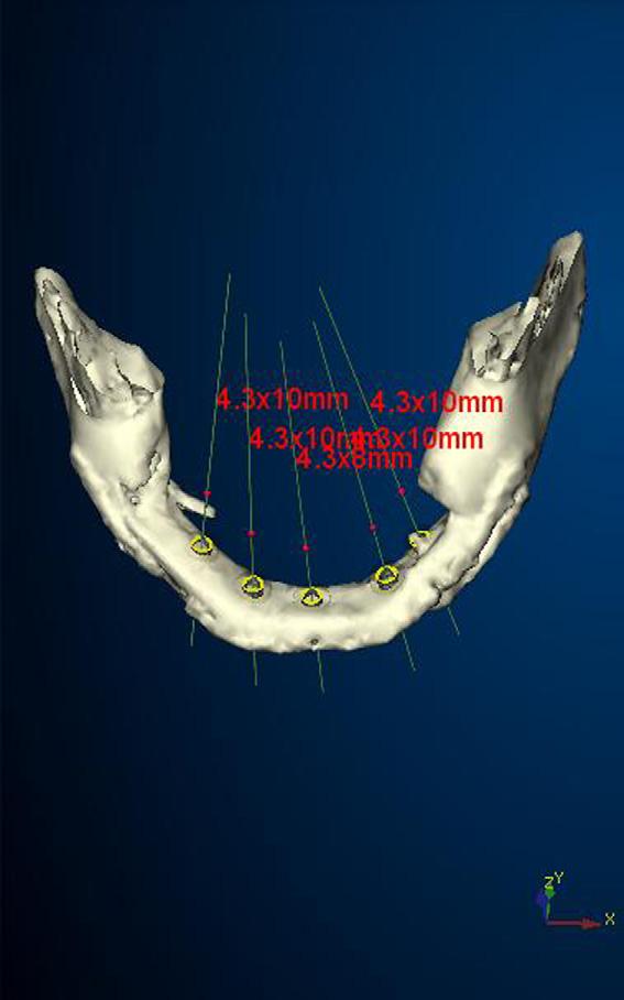The surgical template was oriented using a surgical index fitted to the opposing arch and fixed with anchor pins.