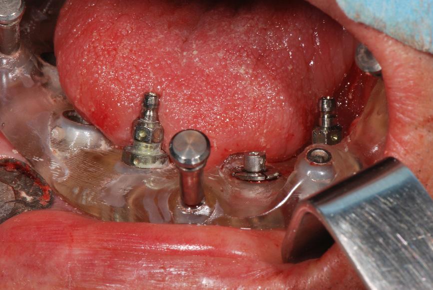 4 G. De Riu et al. / British Journal of Oral and Maxillofacial Surgery xxx (2011) xxx xxx Fig. 3.
