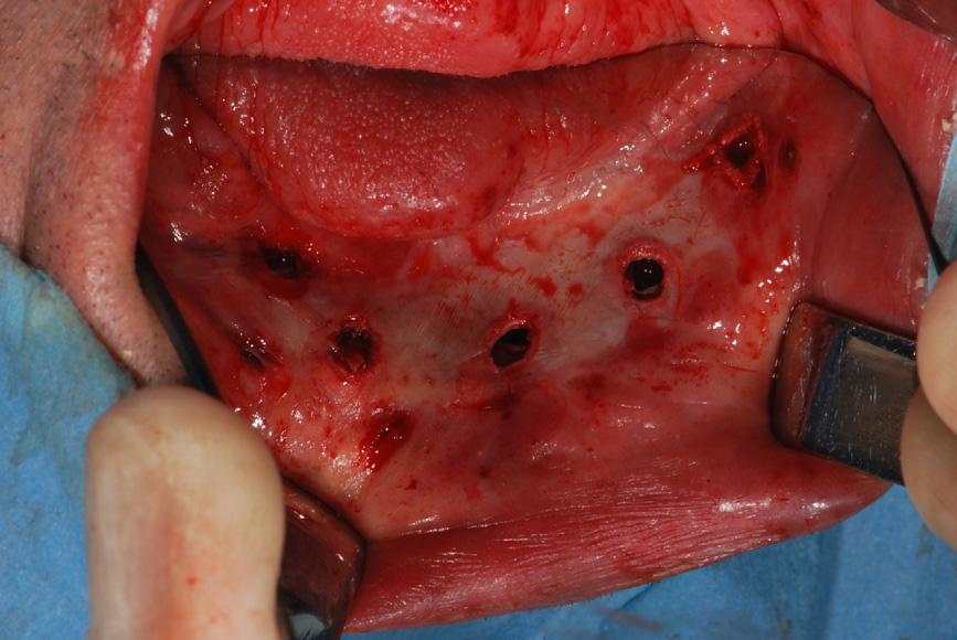 A mandibular reconstruction procedure done without this understanding may provide continuity of the mandible, but may leave the patient crippled, aesthetically and functionally.