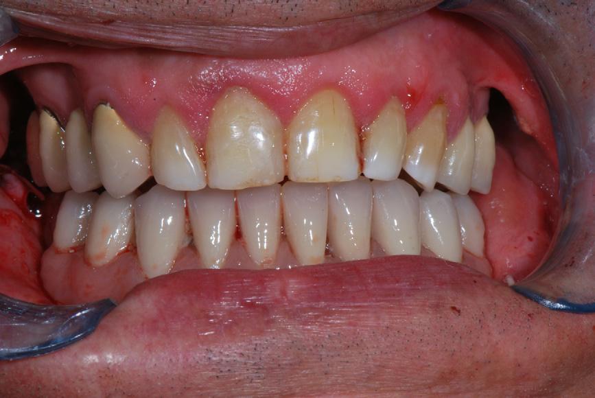 G. De Riu et al. / British Journal of Oral and Maxillofacial Surgery xxx (2011) xxx xxx 5 Fig. 5. Prosthetic restoration (immediate loading).