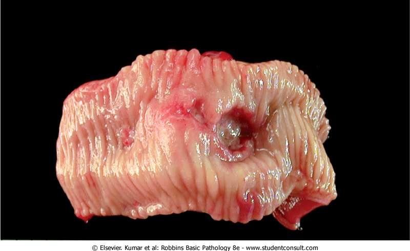 Peptic ulcer of the duodenum.