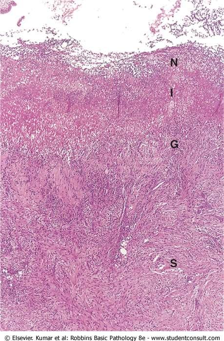 the base of a nonperforated peptic ulcer, demonstrating the layers of necrosis (N), inflammation (I),