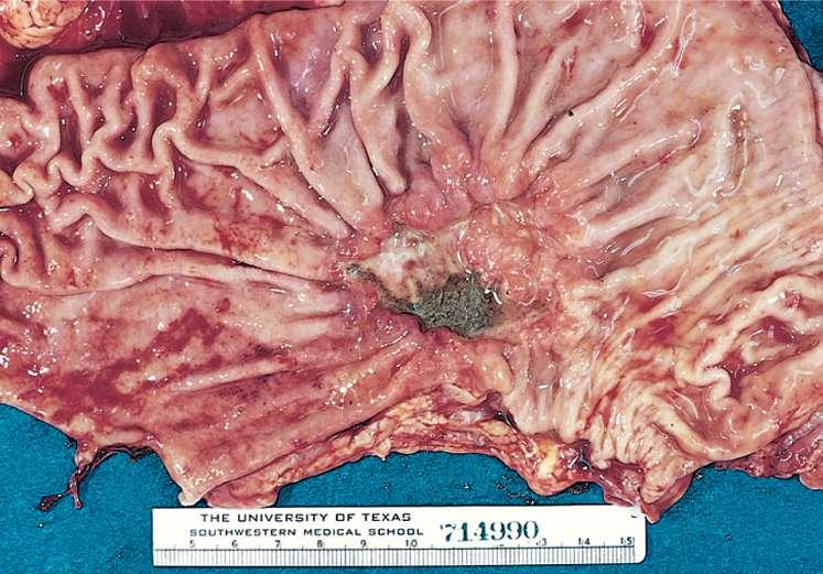 Ulcerative gastric carcinoma. The ulcer is large with irregular, heaped-up margins.