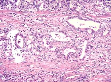 intestinal type of gastric carcinoma with gland formation by