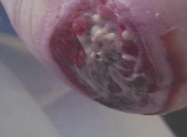 Product FOCUS Left to right: Figure 3: Wound is very sloughy with some necrosis. Periwound skin is macerated. Commenced dressing wound with ActivHeal Aquafiber.