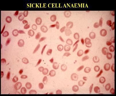 Sickle Cell Anemia Abnormal Haemoglobins (Haemoglobinopathies): Some Known Haemoglobin Mutants : (all in beta chain) Target cells + sickle shape Name Hb. S Hb.