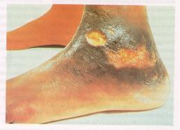 Childhood) (Association with Thalassaemias) CNS Presentations Leg Ulceration