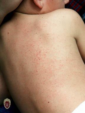 a. This 7-year-old boy has petechiae from thrombocytopenia