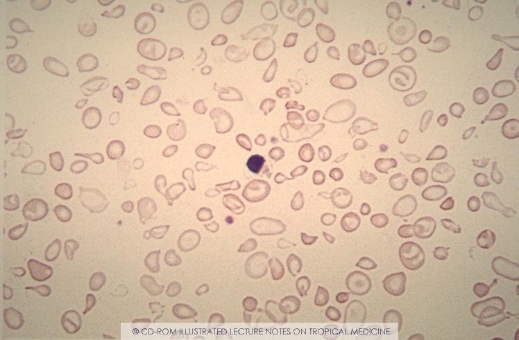 Morphology: Thalassemia β-thalassemia major Poikilocytosis (variation in cell size),