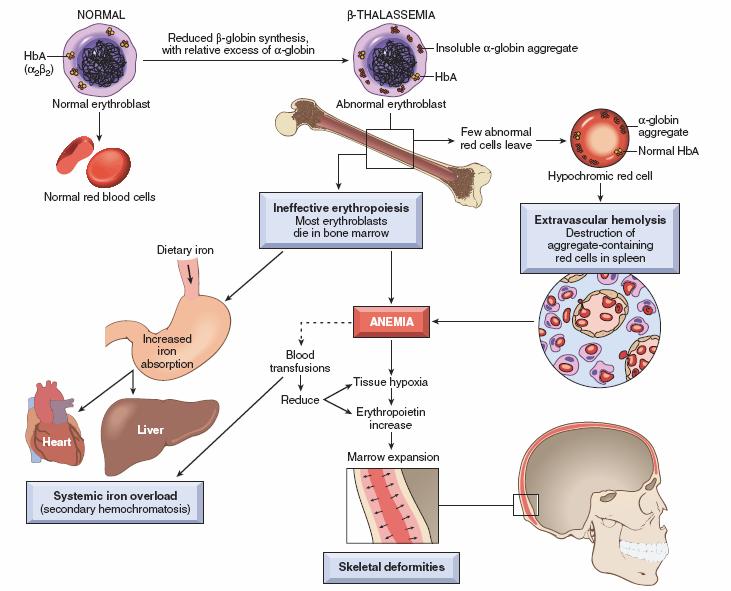 β Thalassemia Microcytic hypochromic anemia