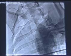 catheter caused by the jet of fluid flowing from its distal