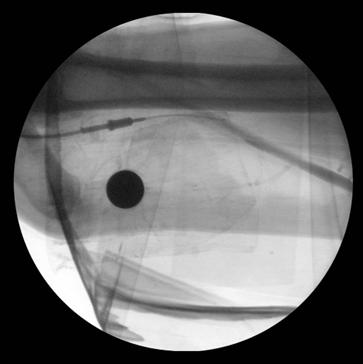 Results Using a transparent dressing for both IAG and Diffusics catheter stabilization there were no episodes of catheter hub movement in this acute model.