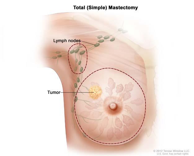 Mastectomy With a mastectomy, the surgeon removes the whole breast that contains the DCIS or cancer. There are two main types of mastectomy.