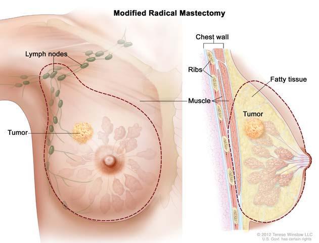 Modified radical mastectomy. The surgeon removes your whole breast, many of the lymph nodes under your arm, and the lining over your chest muscles.