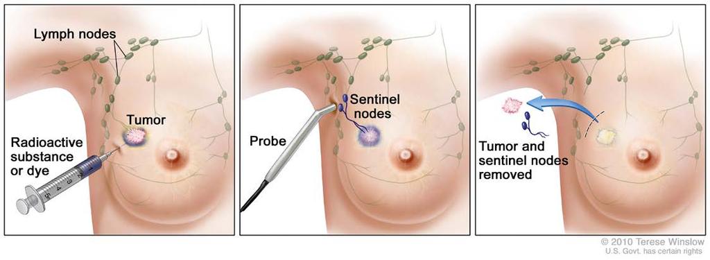 Sentinel Lymph Node Biopsy is a type of surgery in which the surgeon removes a few lymph nodes for testing.