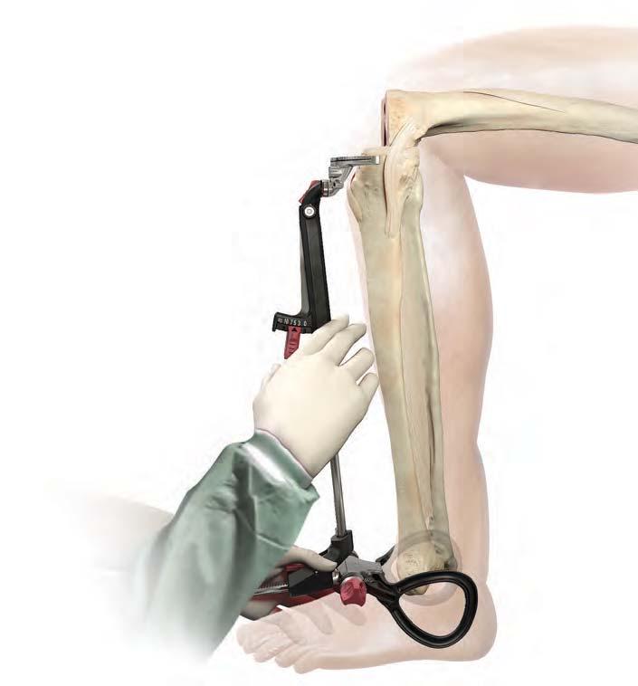 Tibial Alignment and Resection Pinch Lever Set the tibial posterior slope as depicted on the Proximal Uprod of the Tibial Jig, according to the recommendations depending on the appropriate implant