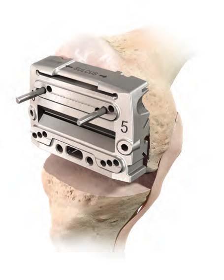The flexion space can be checked by using a Spacer Block placed below the A/P Chamfer Block with the Modular Posterior Saw Capture removed.