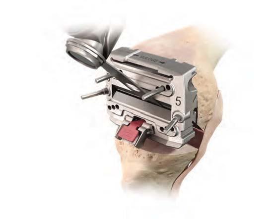 Femoral Preparation Place Retractors to protect the medial and lateral collateral ligaments and the popliteal tendon.
