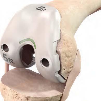 Femoral Trial M/L width of box is representative of implant and cement mantle. The Femoral Trial should be fully seated prior to joint reduction.
