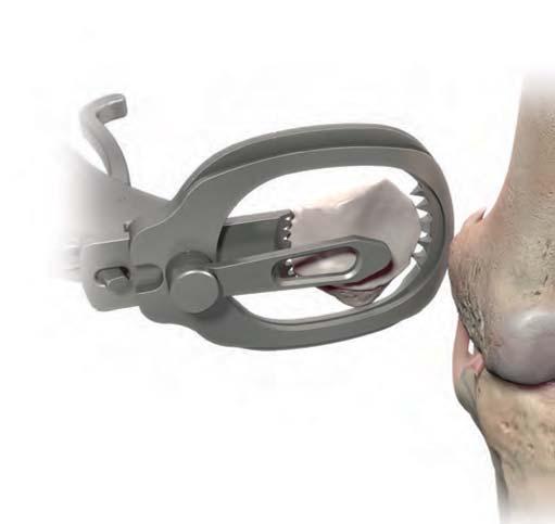 Position the Patella Resection Guide so the Height Gauge is against the articular surface of the patella. Align the serrated jaws at the medial and lateral margins of the articular surface.
