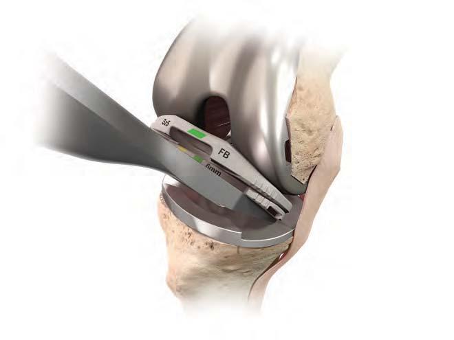 Tibial Trial Extractor With the knee in flexion, the surgeon inserts the Tibial Trial Extractor first on the medial side, underneath the Shim and Articulation Surface