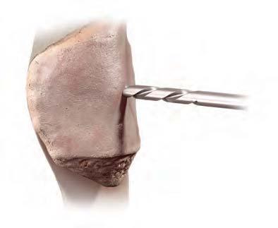 Appendix 1: Optional Patella Drilling Technique Mark the apex of native patella. In most cases duplication of the median crest is recommended.