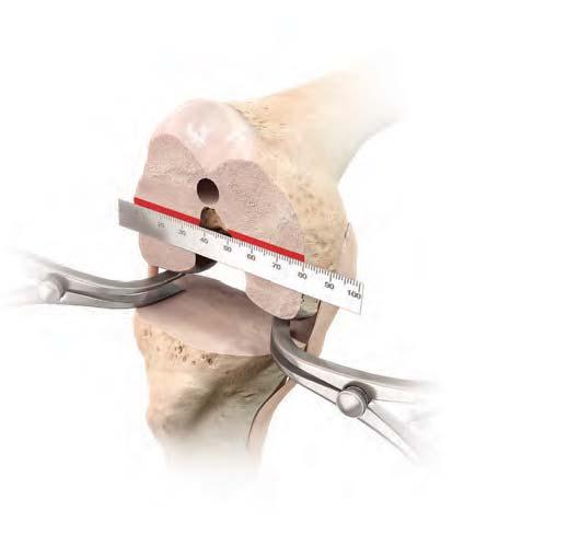 Parallel to the Tibia Tibial Jig Tibial Cutting Guide Option 1: With appropriate tension placed on the medial and lateral