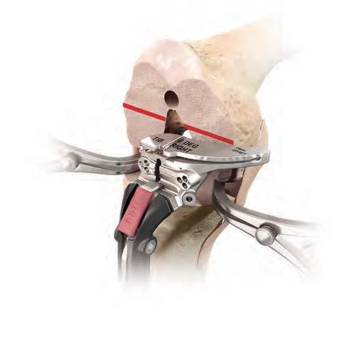 the resected tibial surface by using the edge of an Osteotome or a General Medical Ruler.
