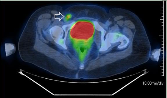Journal of Gastrointestinal Oncology, Vol 5, No 1 February 2014 E9 Figure 2 PET-CT scan following the initial hemorrhoidectomy showing hypermetabolic FDG uptake in a right inguinal node, suspicious