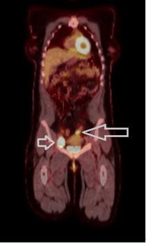 Figure 3 PET-CT done after superficial right groin dissection showing hypermetabolic FDG uptake in the right groin (short arrow) as well as a hypermetabolic soft tissue mass in the left hemipelvis