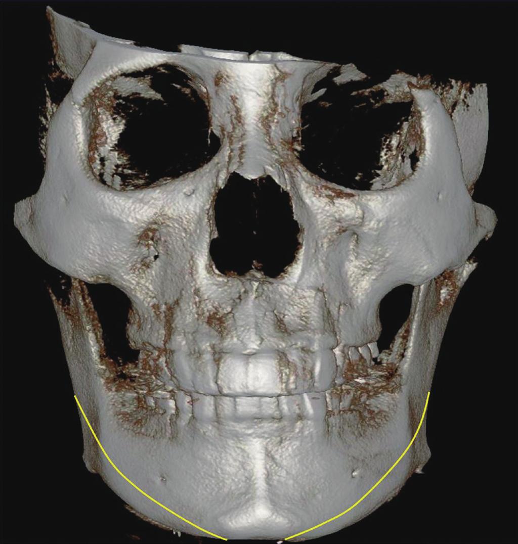 Yoo H-S et al. Extended Long Curved Ostectomy for Madibuloplasty and 1-stage or multistage osteotomy the mandibular angle [1, 10].