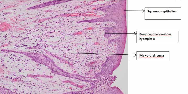 The histopathology (Figures 3 and 4) was reported as a benign fibroepithelial polyp (epulis).