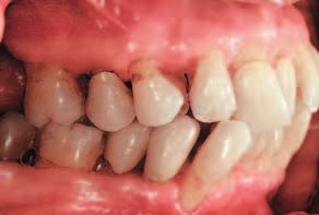 The papilla between tooth 22 and 23 is no longer visible and