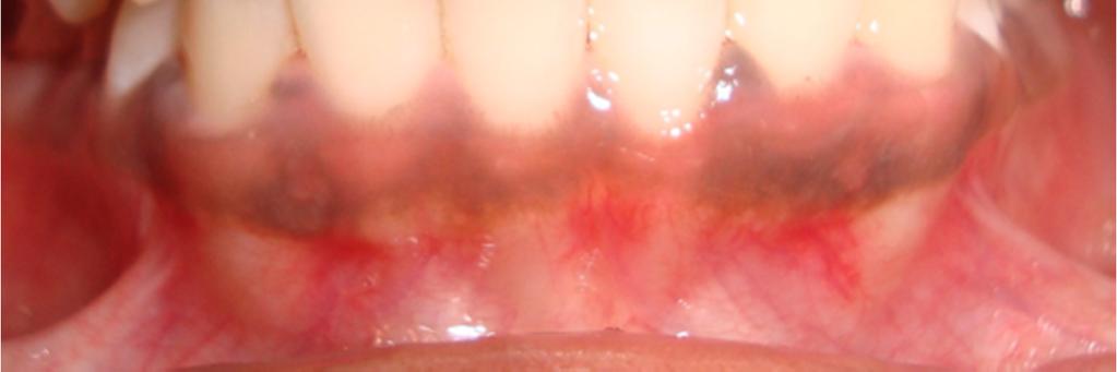 On smiling the patient presented a 4mm of gingival display especially with respect to the lateral incisors and a flat gingival architecture.