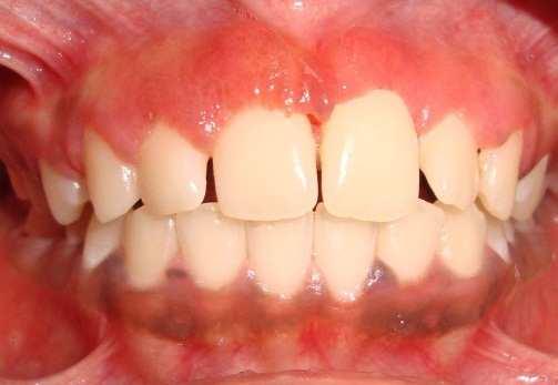 Clinical analysis by periodontal probing highlighted a shorter length of the crowns of the incisors. The patient also exhibited crowding of the maxillary central incisors and the mandibular anteriors.