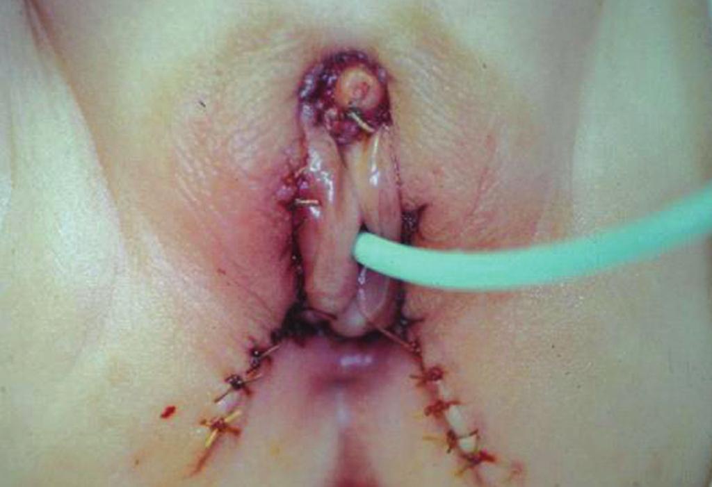 None None *Urethrovaginal fistula; Under general anesthesia; Clitoroplasty at the age of 4 months and Gonzalez operation at the age of 32 months.
