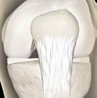 Under direct visualization, insert a needle anterior to the medial femoral condyle and above the medial meniscus to avoid damage.