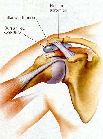 Subacromial Impingement Area between humeral head and acromion Narrowed space Bony