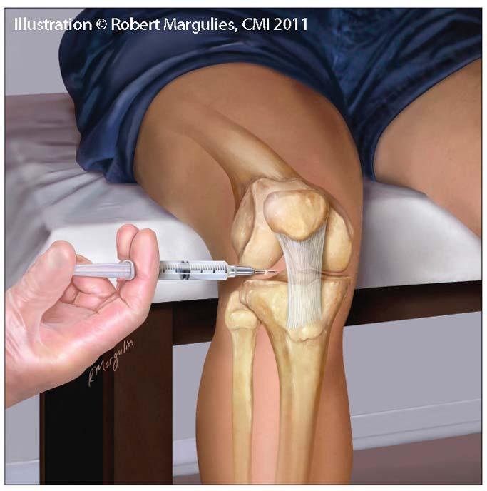 Approach to Knee Injection Flexed