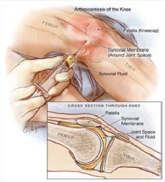 Anterolateral joint line Extended