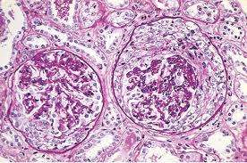E. RAPDILY PROGRESSIVE (CRESCENTERIC) GLOMERULONEPHRITIS (GOODPASTURE SYNDROME) CC/HPI: A 25 year old male complains of a chronic cough for several months accompanied by lightheadedness, fatigue, and